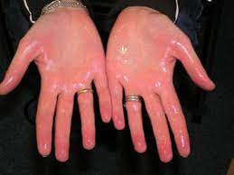 أسباب تعرق اليدين